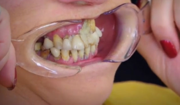 effrayee-par-les-dentistes-elle-recolle-repare-ses-dents-avec-glue-colle-carnage-2